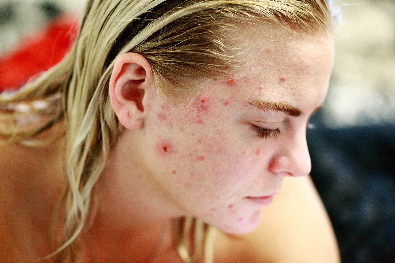 Treatments For Acne Scars